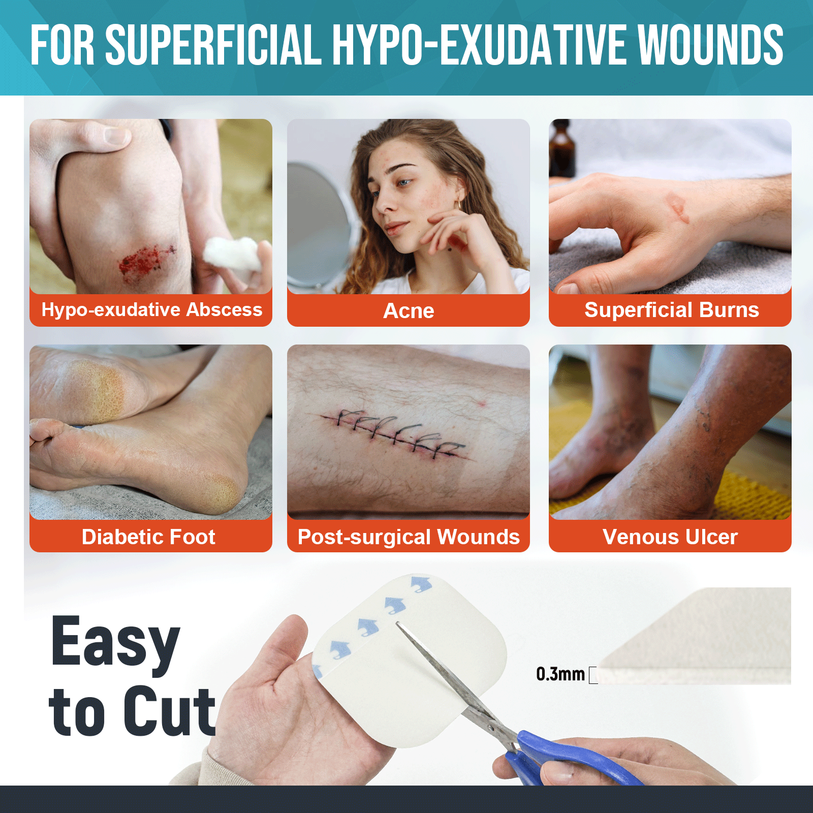 when to stop using hydrocolloid dressing for First & Second-Degree Burns Hydrocolloid dressings: the essential guide