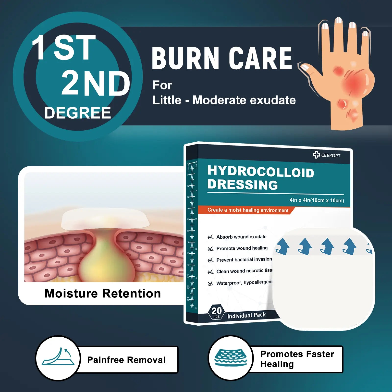 Hydrocolloid Dressing for Little or Moderate Exudate, Non-Infected, Burn Wound