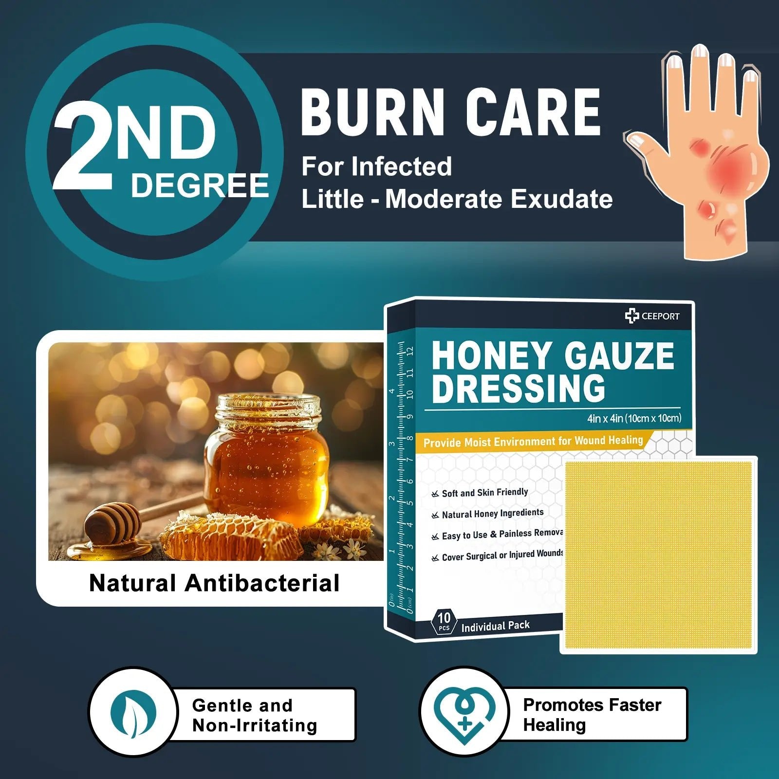 Honey Gauze Dressing for Second-Degree Burns