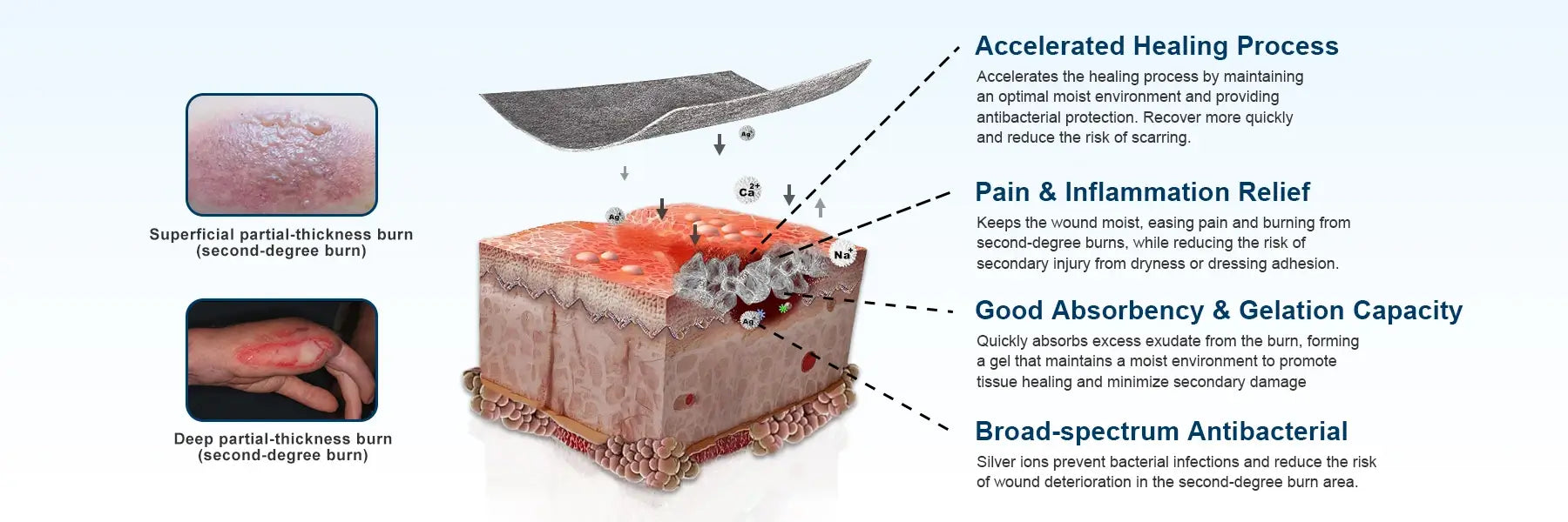 Silver ion alginate dressing with four key benefits: accelerates wound healing, relieves pain and inflammation, superior absorption capacity, and broad-spectrum antibacterial properties for effective wound care.