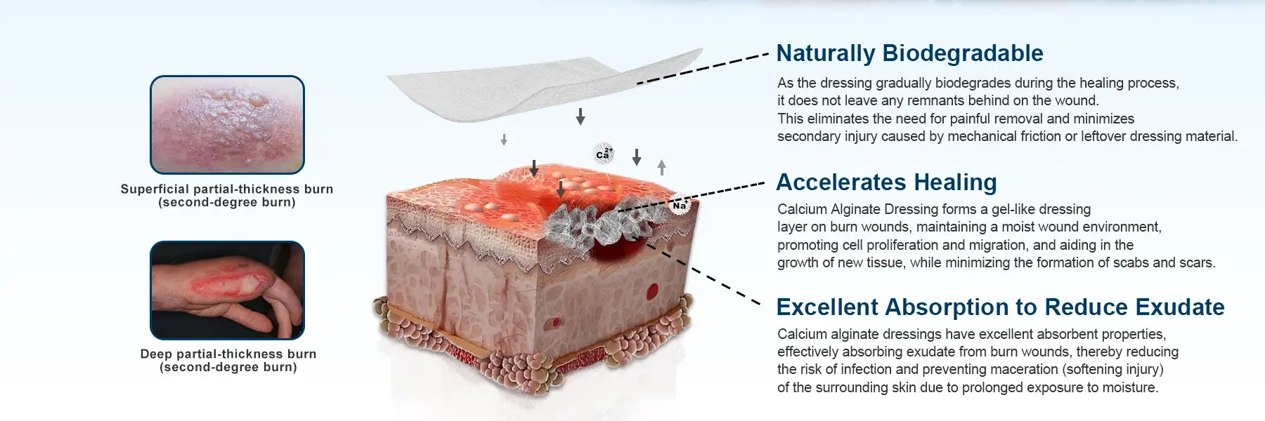 Calcium alginate dressing with natural biodegradability, accelerates healing, and superior absorbent capacity for faster wound recovery.