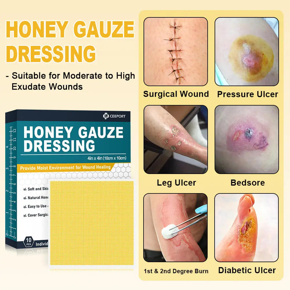 Highly absorbent Manuka honey gauze dressing for managing exuding wounds