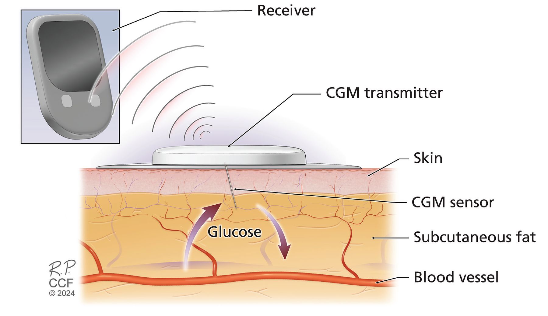 Continuous Glucose Monitoring (CGM): A Smarter Way to Manage Diabetes