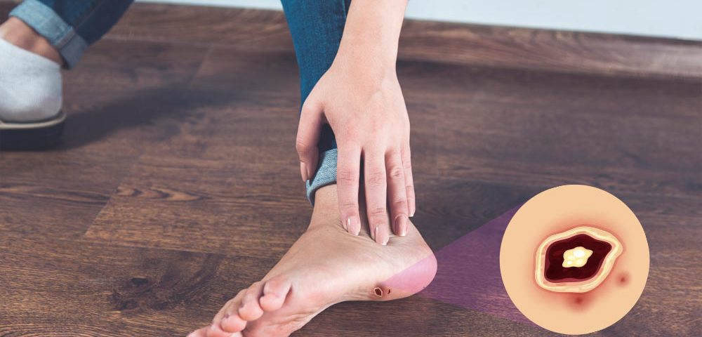 Comprehensive Guide to Diabetic Foot Ulcer Wound Care Dressing
