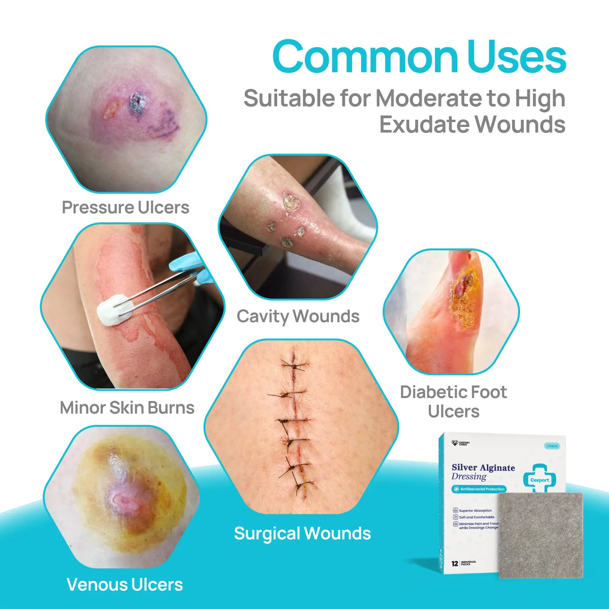 Silver Alginate Wound Dressing for 2nd Degree Burn, Antibacterial, Highly Absorbent & Non-stick