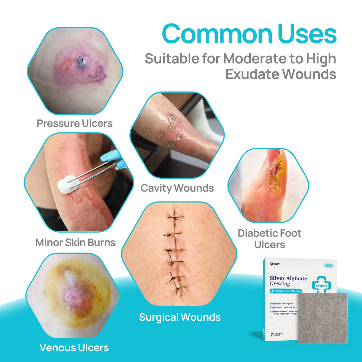 Silver Alginate Wound Dressing for 2nd Degree Burn, Antibacterial, Highly Absorbent & Non-stick