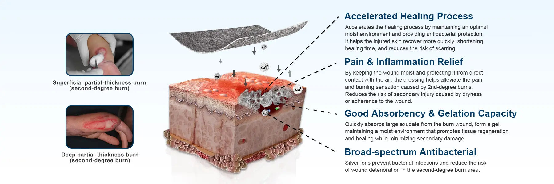 Silver ion alginate dressing with four key benefits: accelerates wound healing, relieves pain and inflammation, superior absorption capacity, and broad-spectrum antibacterial properties for effective wound care.