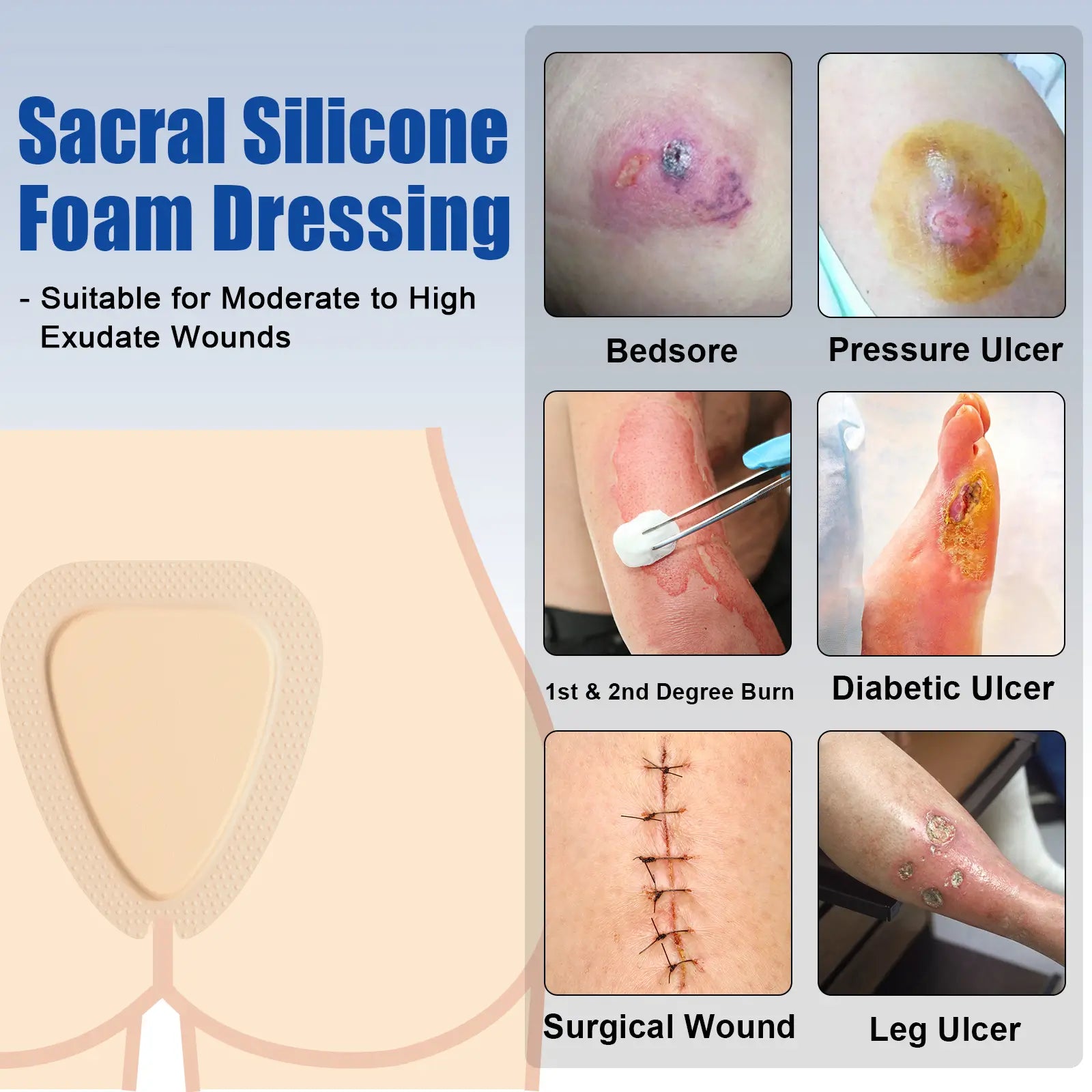 Sacral silicone foam dressing for pressure ulcers, bedsore, offering advanced cushioning and protection